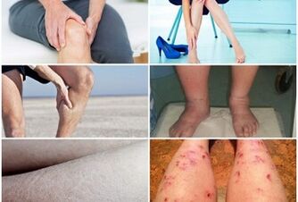 علائم واریس روی پاها