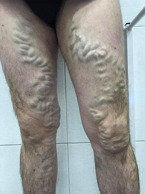 رگ های واریسی مردانه نادیده گرفته شده است