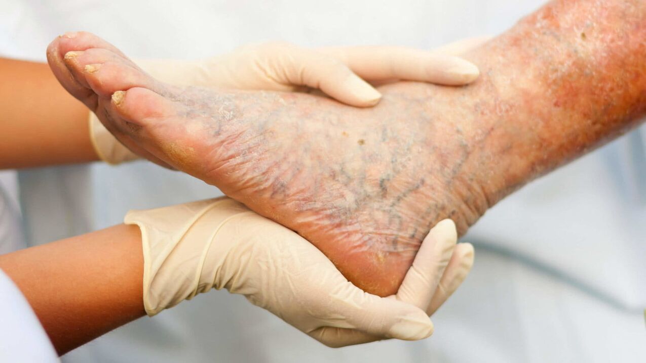 فلبولوژیست با درمان واریس در پاها سروکار دارد
