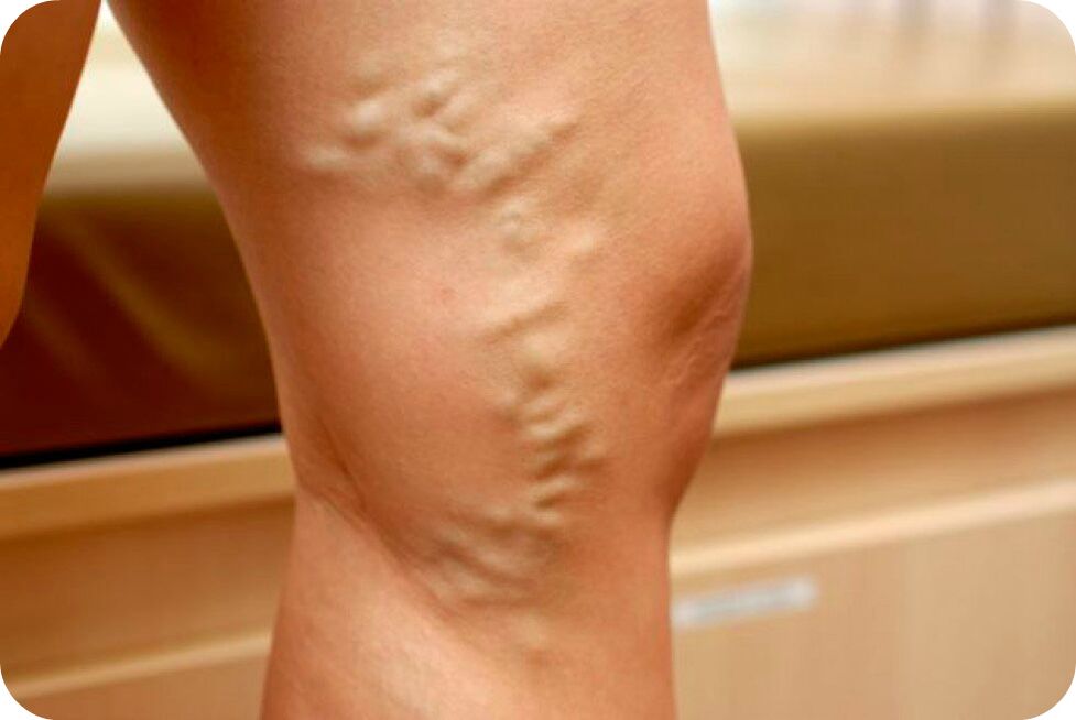 رگهای واریس رگها
