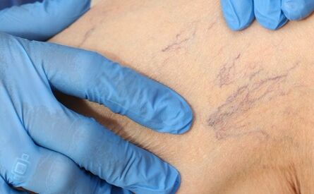 علائم رگهای واریس