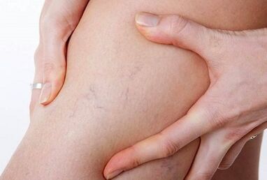 اقدامات ممنوع برای رگهای واریس