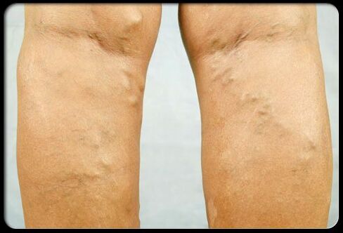 رگهای واریس روی پاها