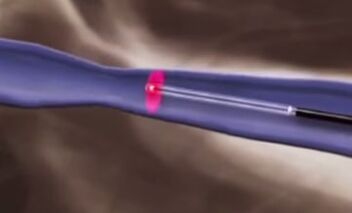 درمان های حرارتی